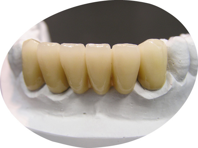 模型に設置された被せものの歯