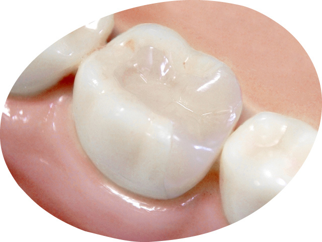 ピカピカツルツルのセラミック素材の歯