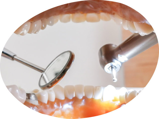 模型の歯を使った歯科治療のイメージ