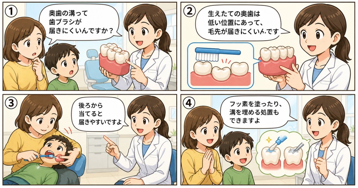 奥歯の溝にできるむし歯の特徴と歯ブラシの当て方